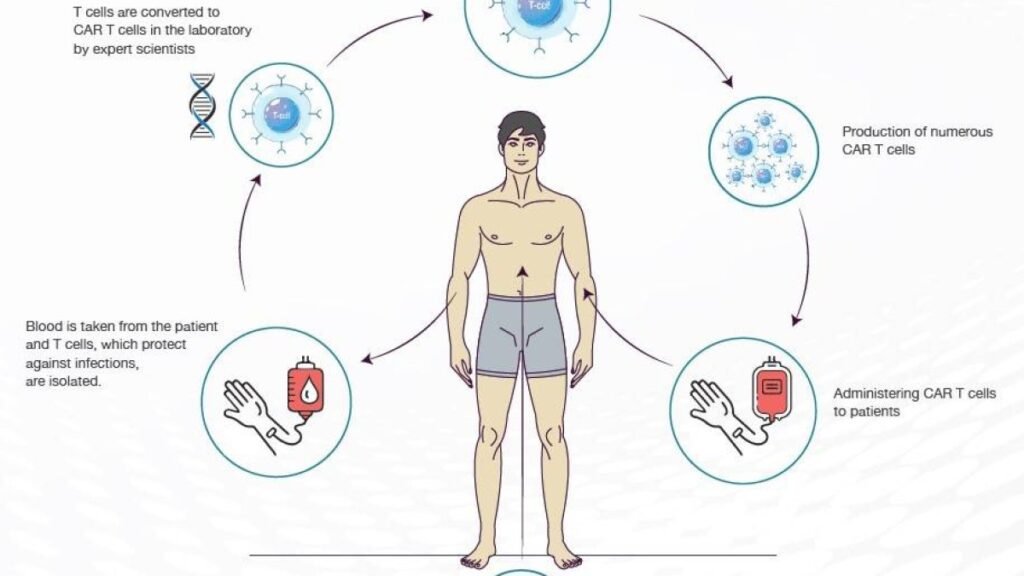 Thérapie CAR-T contre la polyarthrite sévère : trois patients sur six en rémission